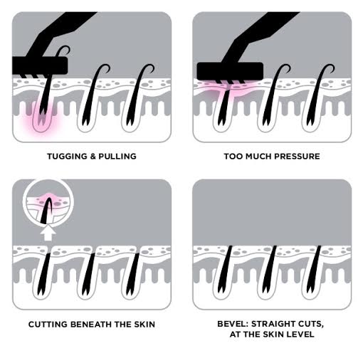 How to stop on sale razor burn